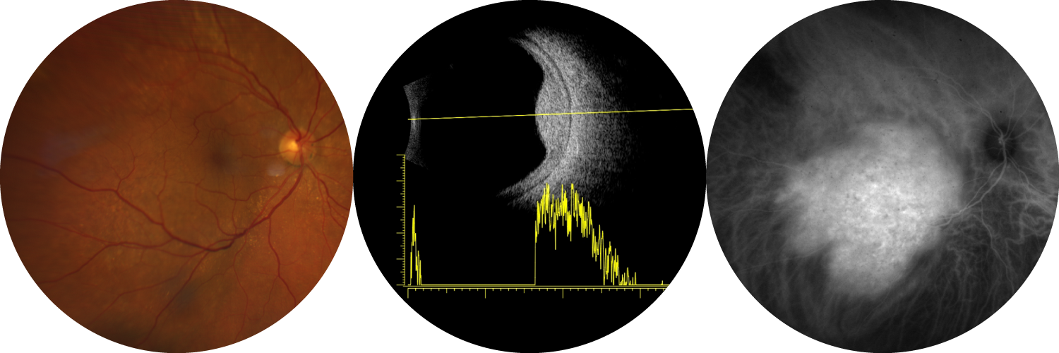 Rétinophotographie, échographie et angiographie ICG d'hémangiome choroïdien