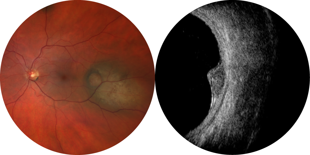 Rétinophotographie et échographie de mélanome choroïdien