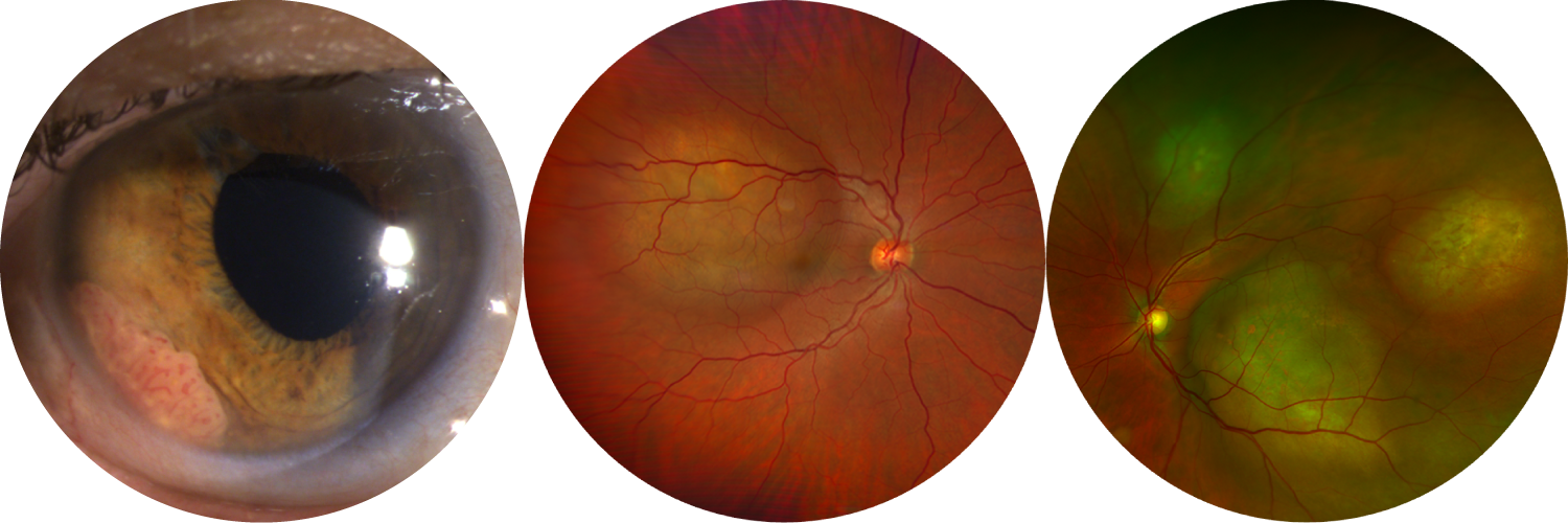 Photographies de métastases irienne et choroïdiennes