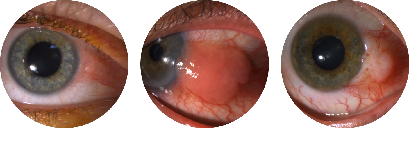 Présentations cliniques des carcinomes et dysplasies