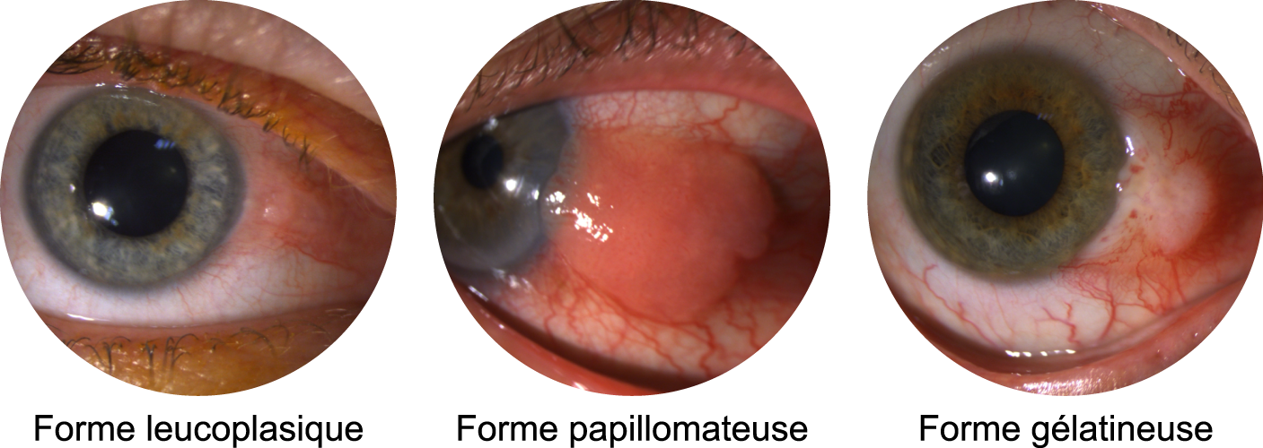 Présentations cliniques des carcinomes et dysplasies