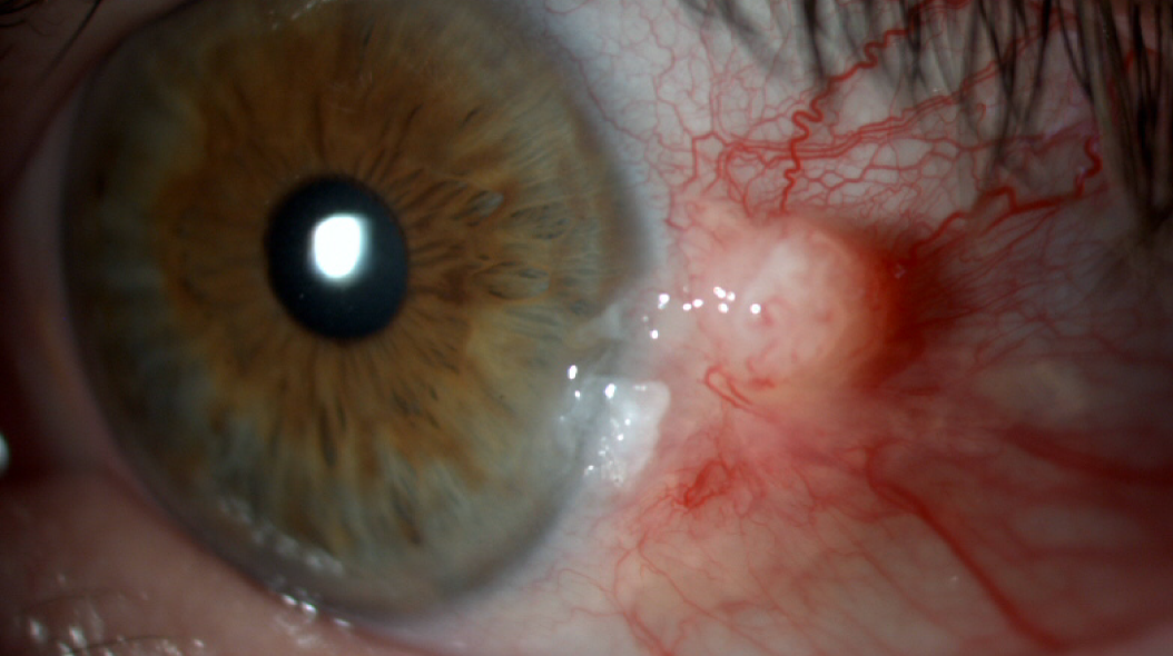 Tumeurs à la surface de l’œil