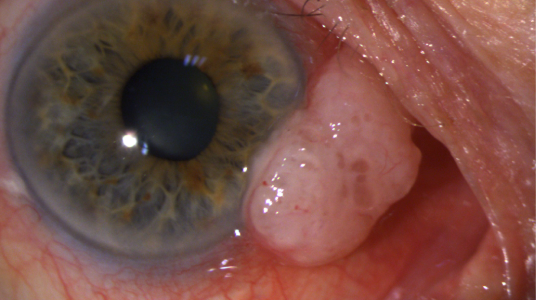 Carcinome conjonctival