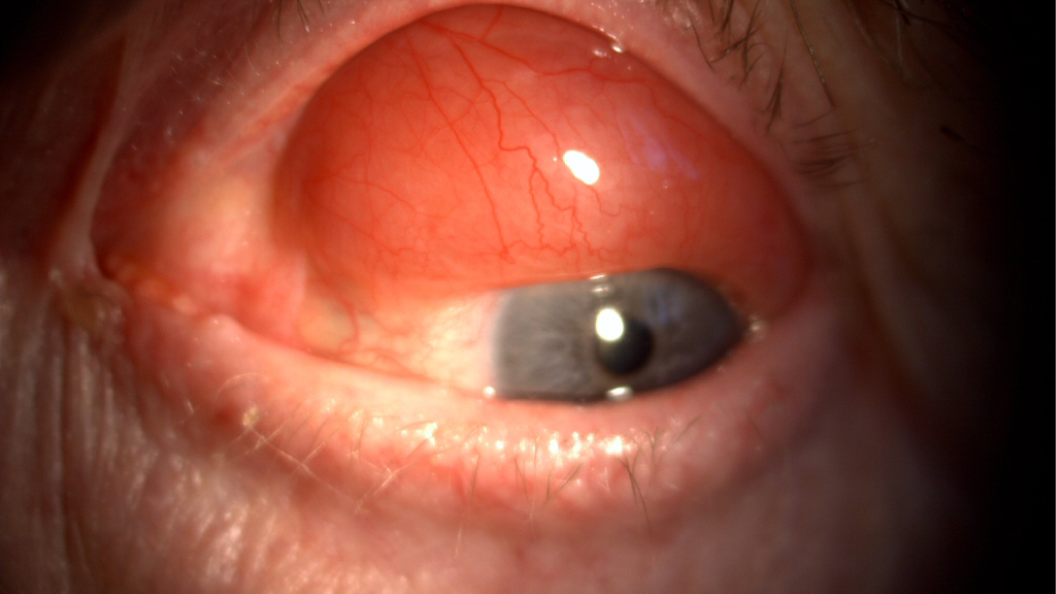 Lymphome conjonctival