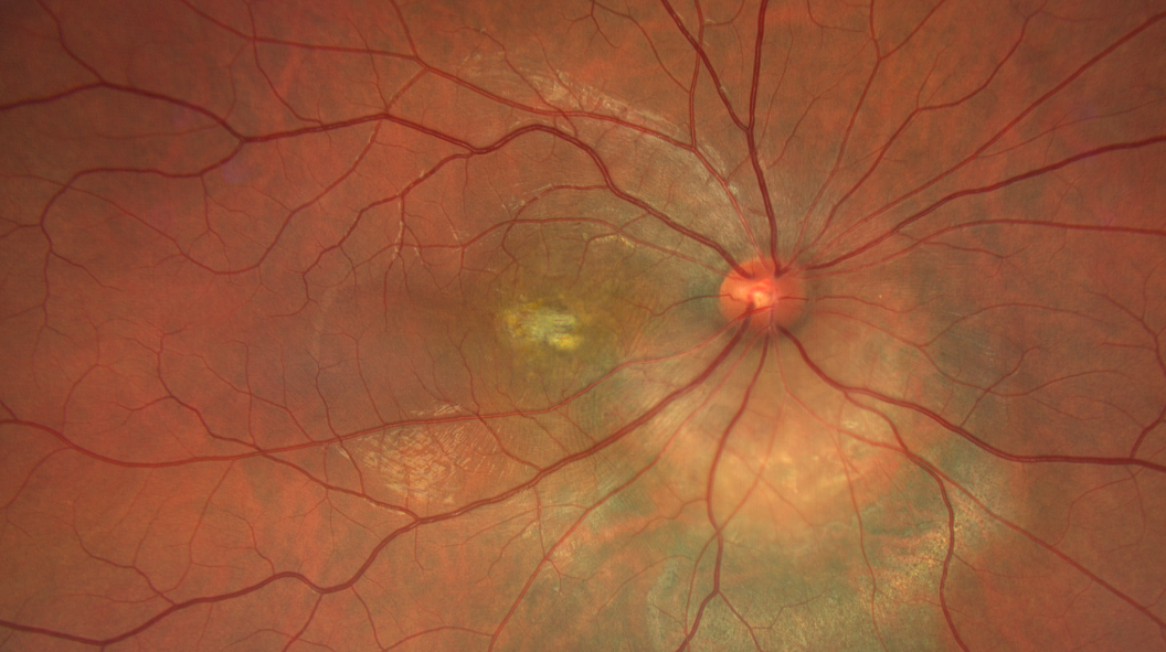 Hémangiome choroïdien