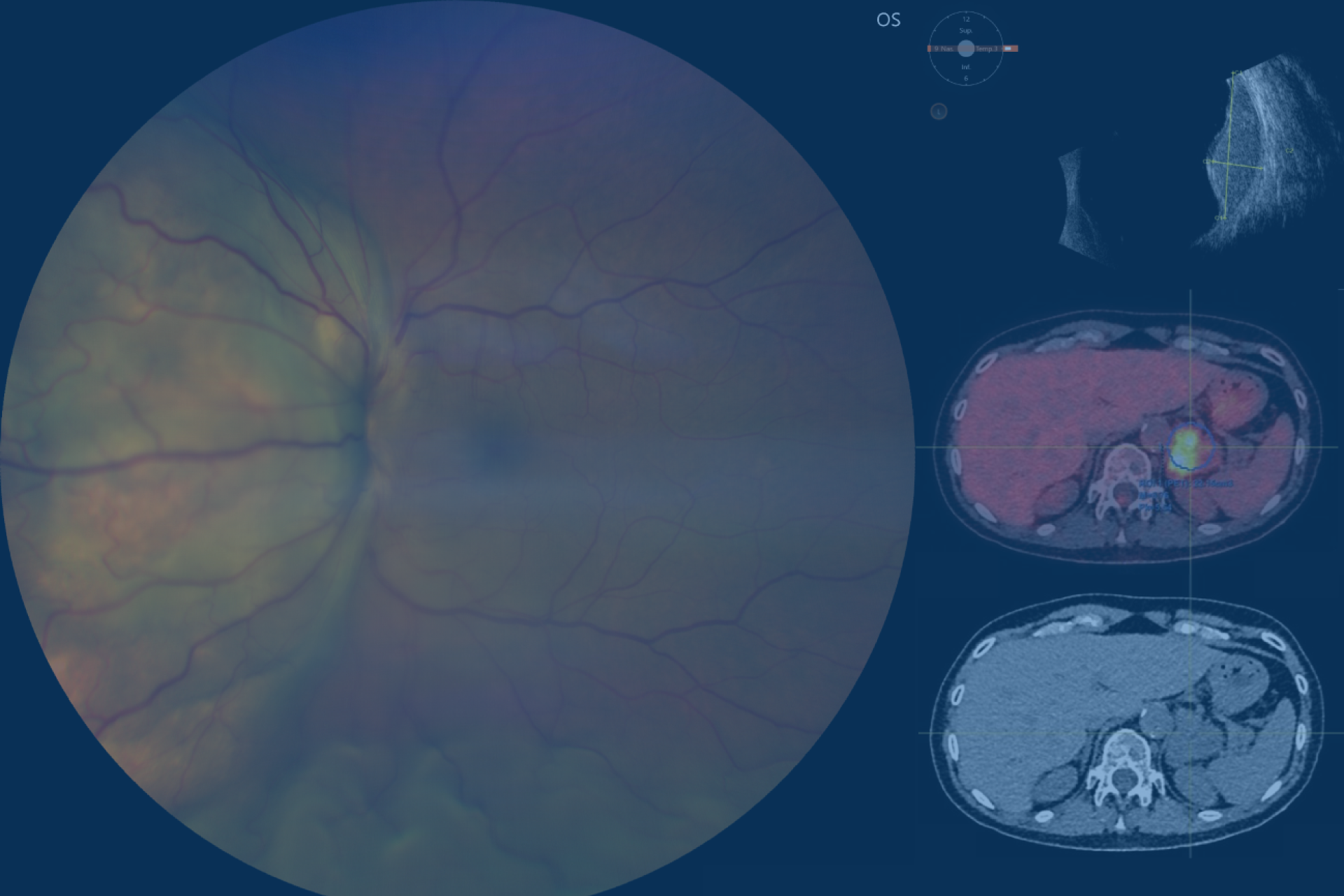 Comprendre le cancer de l’œil